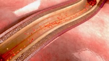 Koroner arter spazmı