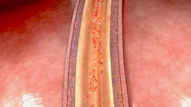 Koroner arter diseksiyonu