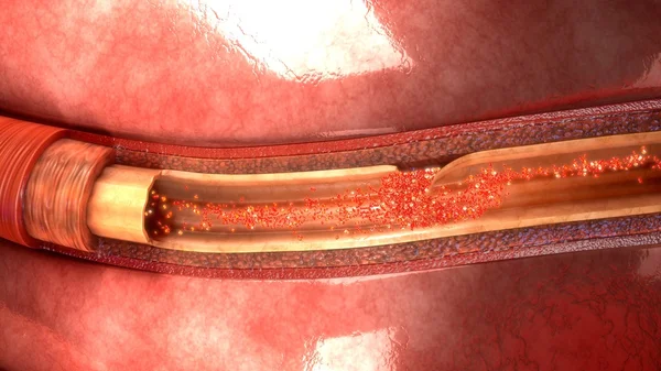 Disección de la arteria sanguínea — Foto de Stock