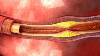Human Artery Atherosclerosis clipart