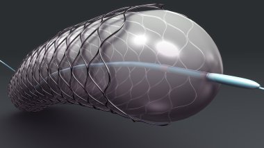 metal endovasküler stent