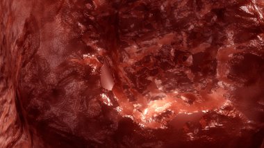İnsan Granuloma inflamasyon