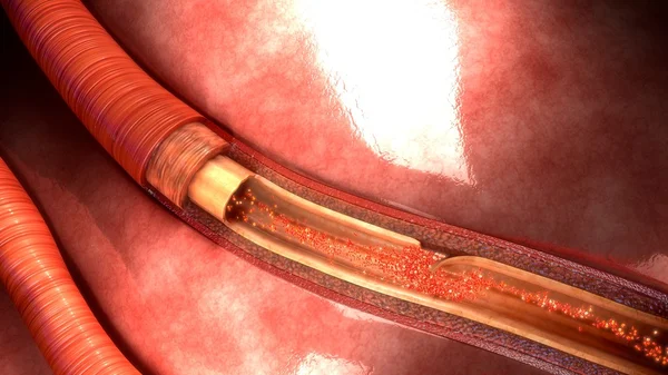 Анатомия рассечения человеческой артерии — стоковое фото