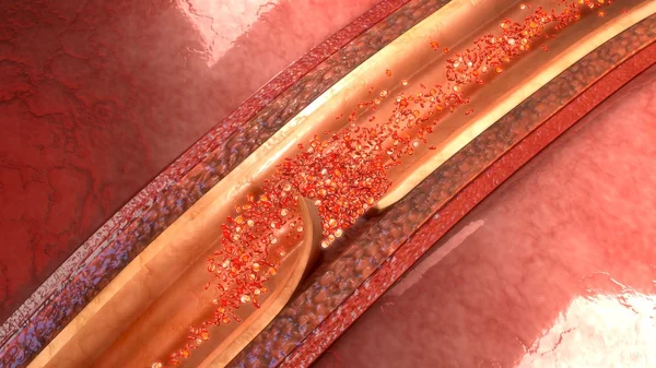 Human artery dissection anatomy — Stock Photo, Image