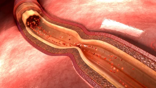 Спазм человеческой артерии — стоковое фото