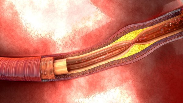 Атеросклероз
