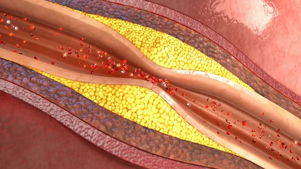 Menselijke slagader atherosclerose — Stockfoto