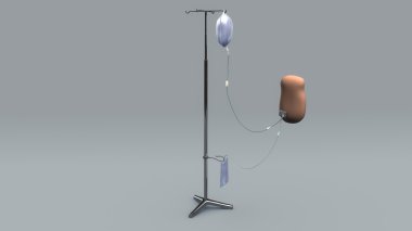 Periton diyaliz donanımları