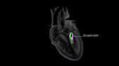 Eine bikuspide Aortenklappe ist eine Aortenklappe, die zwei statt drei Klappen hat. Es kann zu einer verengten oder verstopften Aortenklappenöffnung führen, was es dem Herzen erschwert, Blut in die Hauptschlagader des Körpers (Aorta) zu pumpen.).