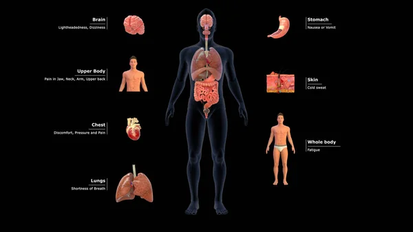 Den Symptomen Zählen Engegefühl Oder Schmerzen Brust Nacken Rücken Oder — Stockfoto