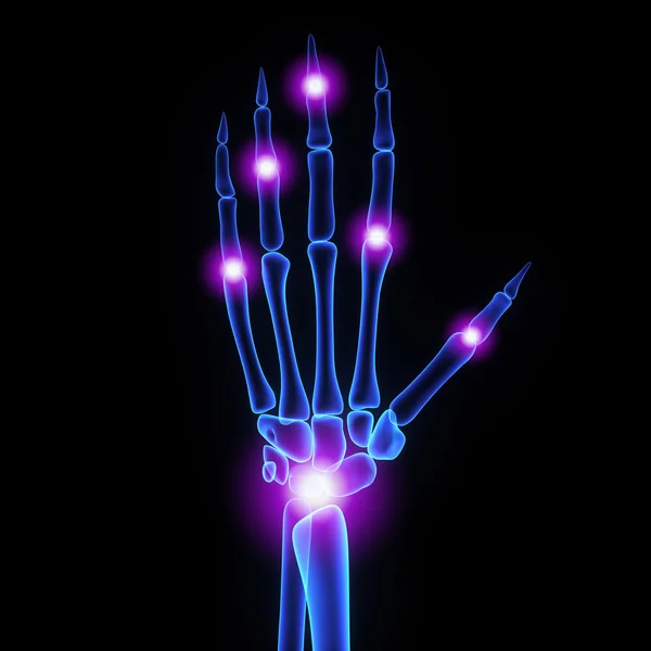 Articulações dos dedos raio-X — Fotografia de Stock
