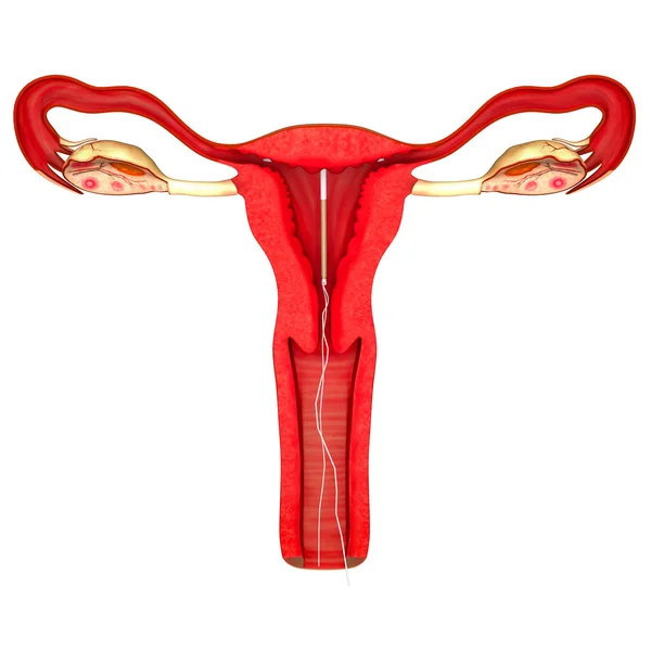 Woman Intrauterine device — Stock Photo, Image