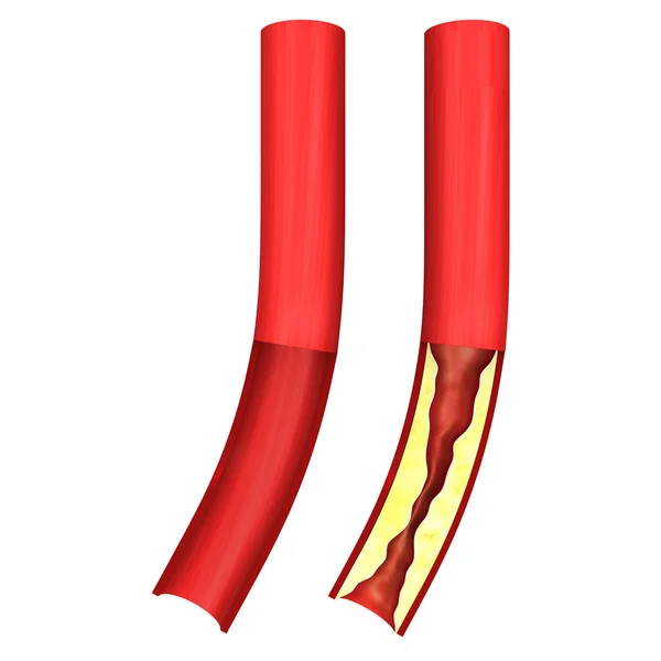 Болезнь коронарной артерии — стоковое фото