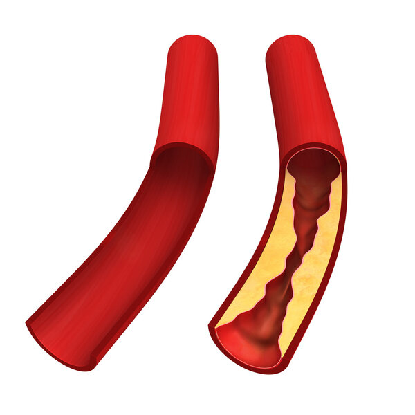 Болезнь коронарной артерии
