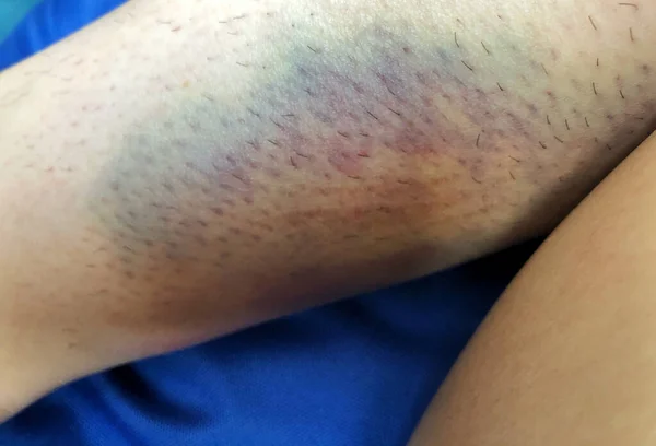 Azul Púrpura Hematoma Perto Perna — Fotografia de Stock