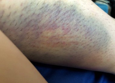 Bacağında mavi-mor morluk var..