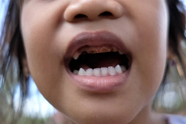 Photo of broken baby teeth