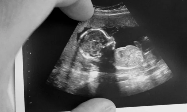 父親の手に赤ちゃんの超音波 — ストック写真