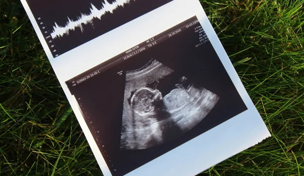 一个婴儿在他父亲手里的超声波 — 图库照片