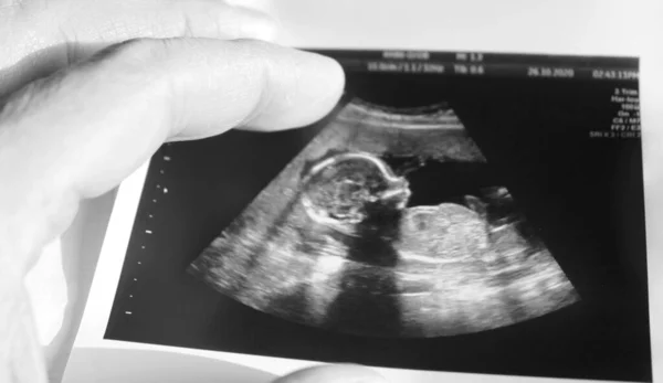 彼の父の手に赤ちゃんの超音波 — ストック写真