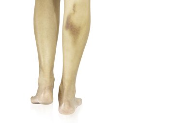 Kırpma yolunda izole edilmiş kadın bacağında büyük çürükler var..