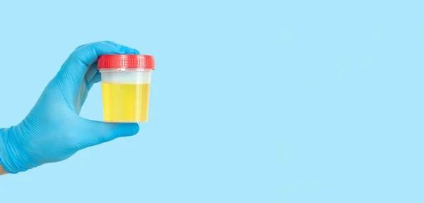 Main Tenant Récipient Échantillon Urine Pour Analyse Urine Médicale Concept — Photo