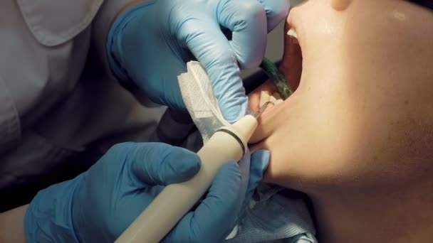 Mujer ultrasónica placa dental odontolito eliminación — Vídeos de Stock