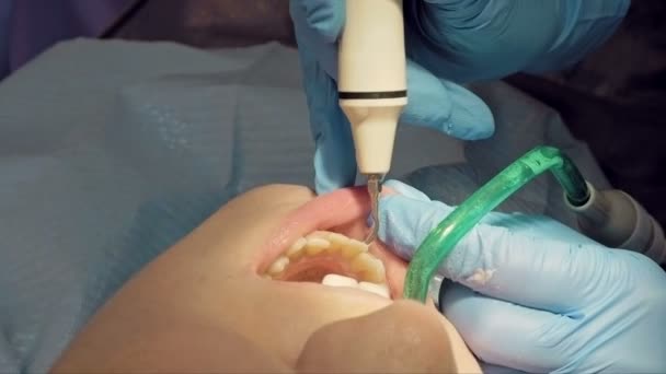 Vrouw ultrasone tand plaque odontolith verwijderen — Stockvideo