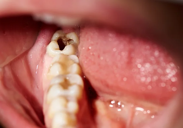 Damaged tooth with cavity dental caries decay — Stock Photo, Image