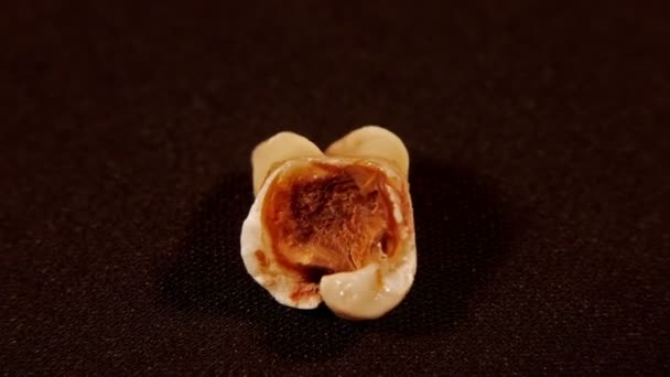 İlmekledi: diş - kavite diş çürüğü çürüme zarar — Stok video