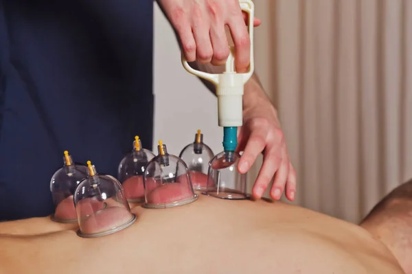 Close Voor Meervoudige Vacuümbekers Medische Cupping Therapie Het Menselijk Lichaam — Stockfoto