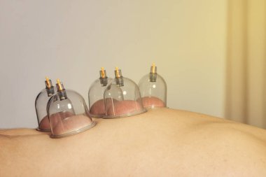 Çoklu vakumlu bardaklar için yakın plan, insan vücuduna uygulanan tıbbi tedavi. Hasta için bardakları olan bir doktor, terapi. Sağlık, sağlık yaralanması rehabilitasyon konsepti. Alternatif tıp. Boşluğu kopyala