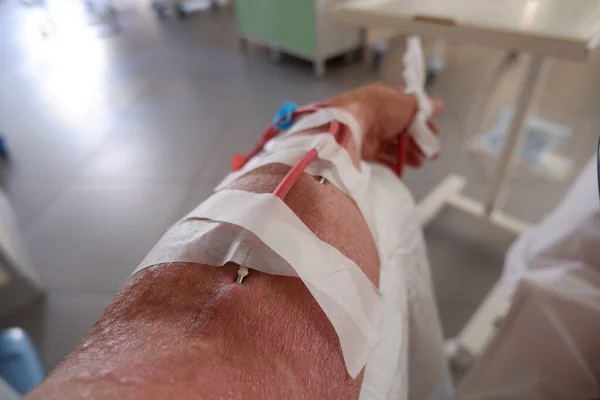 the arm of a patient with chronic kidney disease is connected to a hemodialysis machine.
