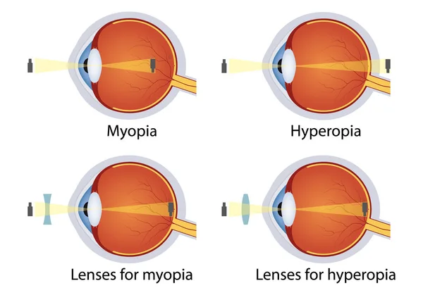 Lenslerle Düzeltilmiş Hiperopi Miyop Göz Kusuru Kavramı Merceğe Göre Çeşitli — Stok Vektör