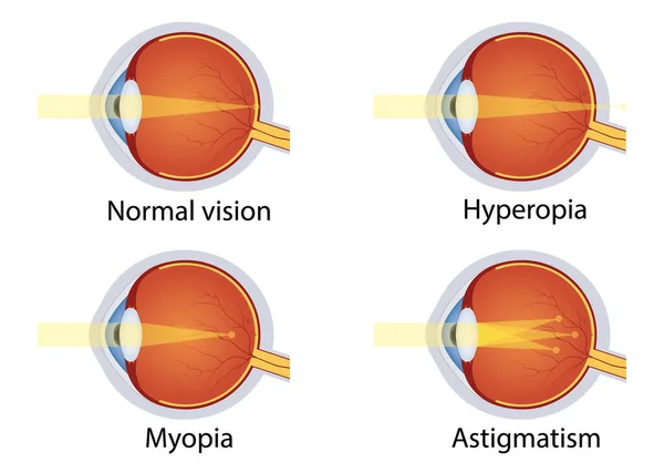 Vision Disorders Concept Eyes Defect Normal Vision Hyperopia Myopia Astigmatism — Stock Vector