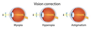 Merceğe bağlı çeşitli göz görme bozukluklarının düzeltilmesi. Hyperopia, miyop, astigmat. Vektör illüstrasyonu