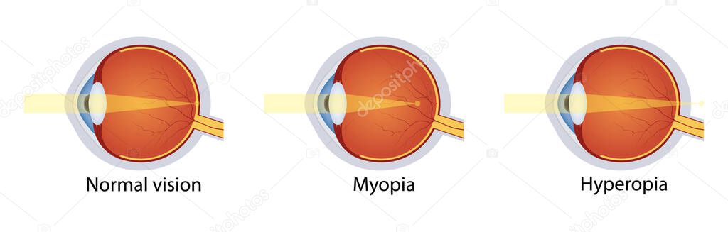 Normal vision, hyperopia, myopia. Set of vision disorders. Anatomy of eyeball defect. Vector illustration