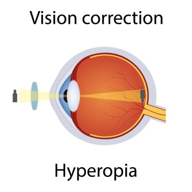 Hyperopia Illustration 'un Vizyon Düzeltmesi. Görme bozukluğu. Convex Lens Kavramına göre Gözler Hatalı Düzeltiliyor. Hyperopia kusurlu Detaylı Anatomi Göz Topu. İzole Vektör