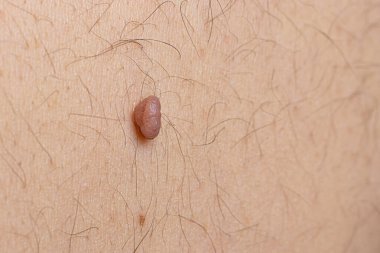 İnsan derisindeki köstebek doğum lekesi Nevus makro fotoğrafı. Kapat..