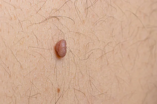 Mole Birthmark Nevus Macro Photo Human Skin Close — Stock Photo, Image