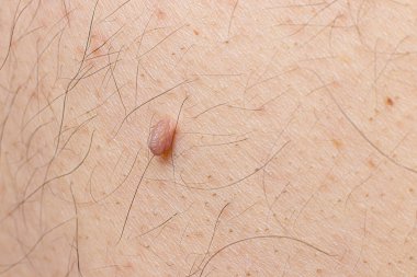 İnsan derisindeki köstebeğin yakın plan fotoğrafı. İnsan derisindeki köstebek doğum lekesi Nevus makro resmi için yer var. Metin için telif alanı olan pankartı kapat.
