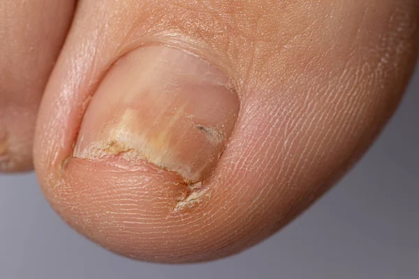 Fungus Nails Big Toe Dermatomycosis Onychomycosis Fungal Infection Macro Photo — Stock Photo, Image