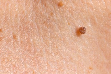 Papilloma on human skin - benign tumor in the form of mole, nevus Papillomatosis medicine clipart