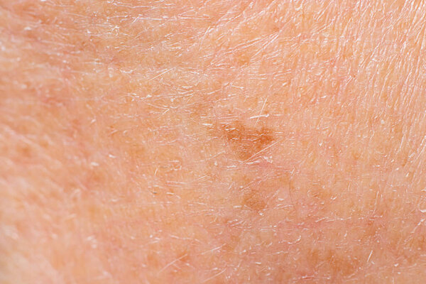 Old spot of lentigo on the skin of a man macro photo. Skin pigmentation with age, pigment spots, skin aging.