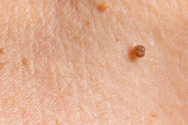 Nsan Derisinde Papilloma Köstebek Şeklinde Iyi Huylu Tümör Nevus Papillomatozis — Stok fotoğraf