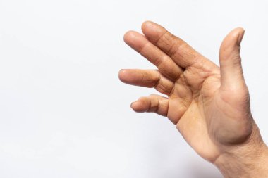 Beyaz arka planda insan el fırçası - eklem ve avuç içi hastalığı, Dupuytren kasılması, parmaklar bükülmez. Tıp ve Travma Bilimi.