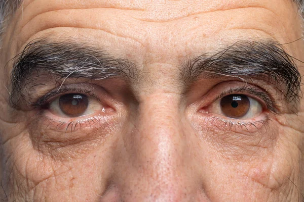 A man with cataracts is a disease of the lens of the human eye, clouding. Comparison of healthy and sick eye.