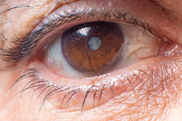 人間の目のマクロ写真 レンズの白内障の雲 視力の悪化 白内障治療 — ストック写真
