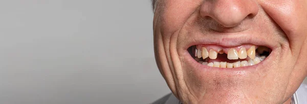 The toothless smile of an old European man on a gray background. Dentistry for pensioners, happy old age