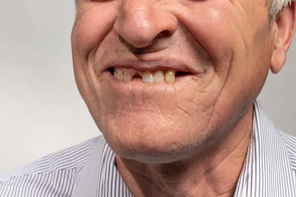 Sorriso Sem Dentes Velho Homem Europeu Sobre Fundo Cinzento Odontologia — Fotografia de Stock